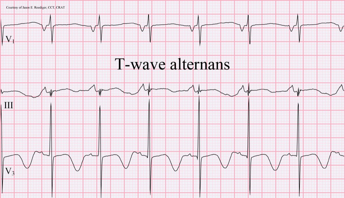 T-wave alternans: T wave amplitude alternates from beat to beat at a constant rate.